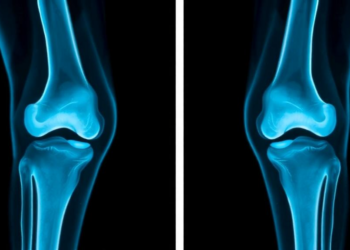 Hybrid AI Reads Knee X-Rays to Catch Osteoporosis Early