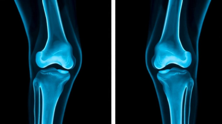 Hybrid AI Reads Knee X-Rays to Catch Osteoporosis Early