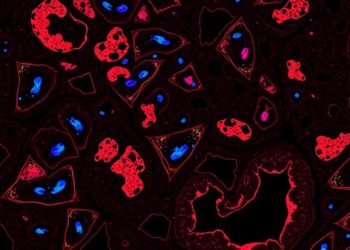 TRK Protein Staining in Childhood Rhabdomyosarcoma Flags Aggressive Tumors but Misses the Gene Fusions That Matter