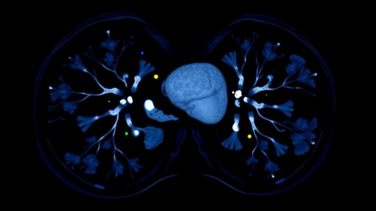 Early PET/CT Scan Predicts Which HER2-Positive Breast Cancers Will Vanish Before Surgery