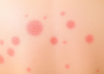 Skin Rash Vanishes When Cancer Drug Targets Inflammation in Rare Syndrome Case