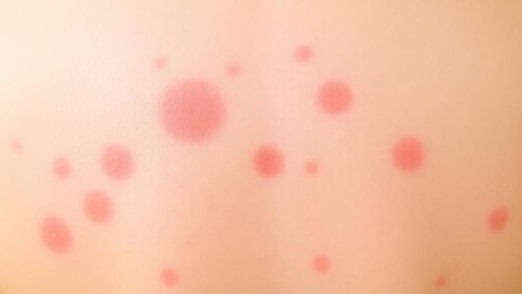Skin Rash Vanishes When Cancer Drug Targets Inflammation in Rare Syndrome Case