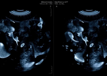 AI Grades Ultrasound Image Quality With 95% Accuracy in Breast Cancer Screening