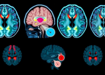 Hybrid AI reads brain scans to stage Alzheimer’s disease in four steps