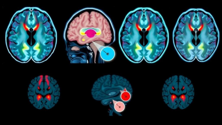 Hybrid AI reads brain scans to stage Alzheimer’s disease in four steps