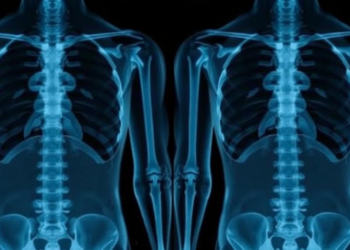 Standing X-Rays May Flag Severe Spinal Disc Herniation, Study Finds