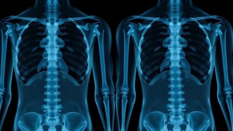 Standing X-Rays May Flag Severe Spinal Disc Herniation, Study Finds