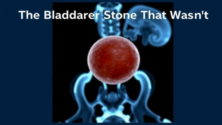 The Bladder Stone That Wasn’t: Rare Urachal Calculus Fooled CT Scans and Cystoscopy