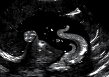 Bladder Debris on Ultrasound in Children: A Clue, Not a Diagnosis, for Urinary Tract Infection