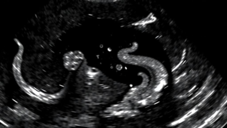 Bladder Debris on Ultrasound in Children: A Clue, Not a Diagnosis, for Urinary Tract Infection