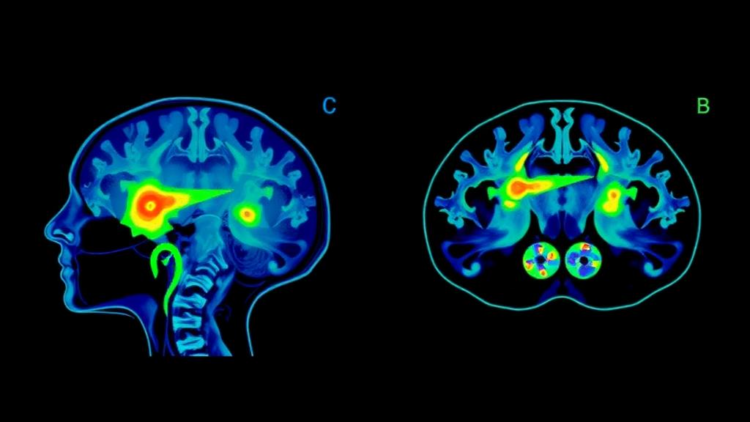 Stimulated Raman Imaging Maps Hidden Bone Damage Around Cancer Metastases