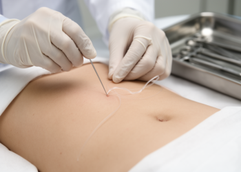 Needle-Implanted Sutures Show Cumulative Weight Loss in Obese Women