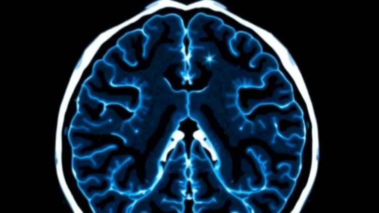 AI Network Sharpens Detection of Dangerous Brain Aneurysms on CT Scans