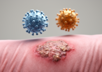 Two Canine Papillomaviruses Found Together in Skin Plaques Tied to Cancer in a Hairless Dog