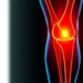 Low-Dose Radiation Therapy Eases Knee Osteoarthritis Pain in Rigorous Sham-Controlled Trial