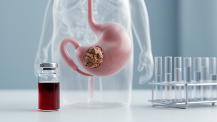 Normal PSA Did Not Save Him: Bladder Cancer Masquerading as Prostate Disease