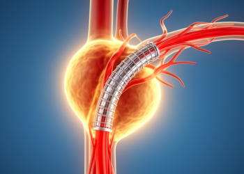 Physician-Modified Endografts Reshape Blood Flow in Complex Aneurysms, Simulations Show
