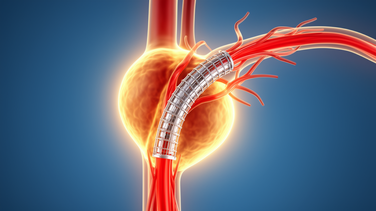 Physician-Modified Endografts Reshape Blood Flow in Complex Aneurysms, Simulations Show