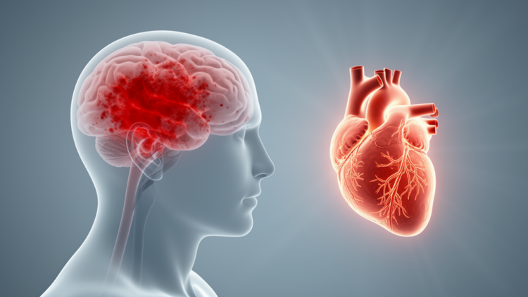 Poor Blood Pressure Control May Drive Fatal Brain Bleeds in Anticoagulated AF Patients