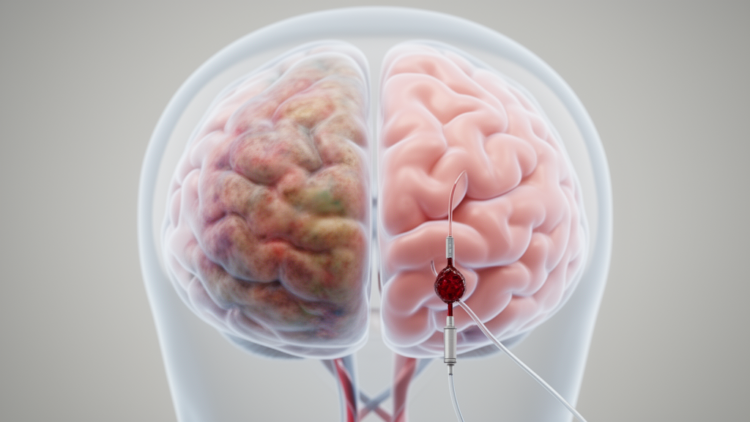Thrombectomy improves functional outcome in large core stroke partly by preventing severe cerebral edema: a real-world mediation analysis