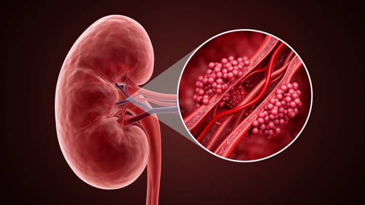 When a Complement Blocker Fails: Malignant Hypertension and a Hidden Blood Protein Behind a Rare Kidney Disease