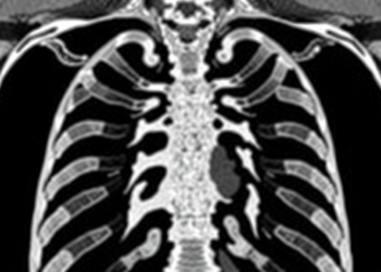 AI Reads Old Rib Fractures on CT Scans With Day-Level Precision
