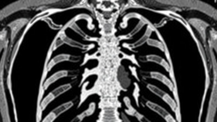 AI Reads Old Rib Fractures on CT Scans With Day-Level Precision