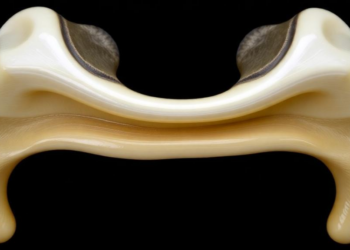 Rare Jawbone Lump in an 18-Year-Old Reveals the Power of Cone-Beam CT