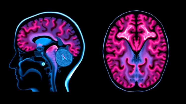 Brain imaging in dystrophinopathies