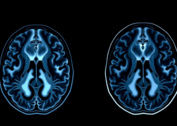 Contrast Enhancement on MRI May Be the Missing Prognostic Variable in IDH-Wildtype Gliomas Diagnosed as Grade 2 and 3