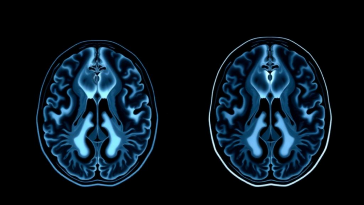 Contrast Enhancement on MRI May Be the Missing Prognostic Variable in IDH-Wildtype Gliomas Diagnosed as Grade 2 and 3