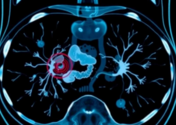 AI Reads Scans to Predict Hidden Spread in Colorectal Cancer Before Surgery