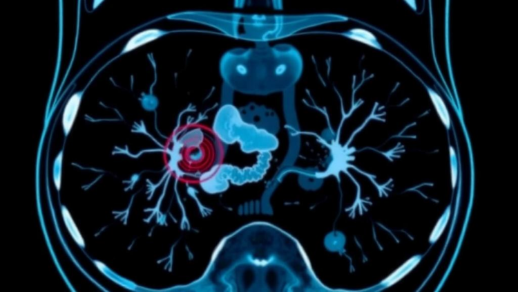 AI Reads Scans to Predict Hidden Spread in Colorectal Cancer Before Surgery