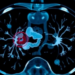 AI Reads Scans to Predict Hidden Spread in Colorectal Cancer Before Surgery