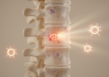 Ultra-Low-Dose Radiation in Just One or Two Sessions Eases Multiple Myeloma Bone Pain