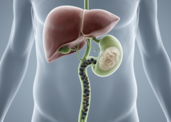 Hidden Bile Duct Tumor Masquerades as Gallstones in Landmark Case Report