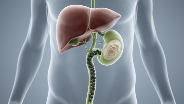 Hidden Bile Duct Tumor Masquerades as Gallstones in Landmark Case Report