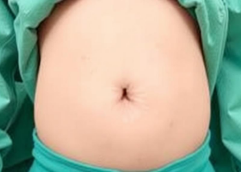 Single-Port Surgery Through the Belly Button Matches Standard Keyhole Repair in Children