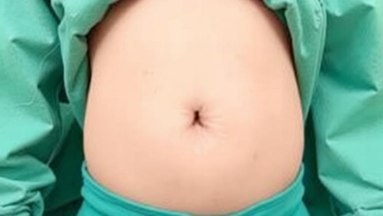 Single-Port Surgery Through the Belly Button Matches Standard Keyhole Repair in Children