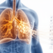 Sjögren’s-Linked Bronchiectasis Findings from National Registry Headed to CHEST 2026