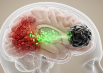 How Stroke Injury Feeds the Brain’s Deadliest Tumors