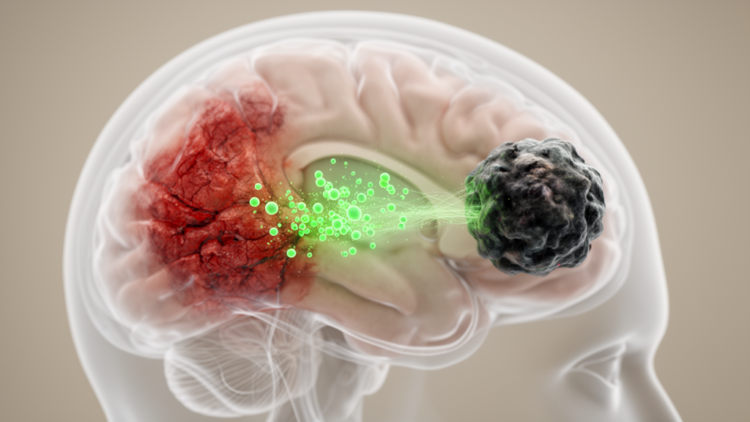 How Stroke Injury Feeds the Brain’s Deadliest Tumors