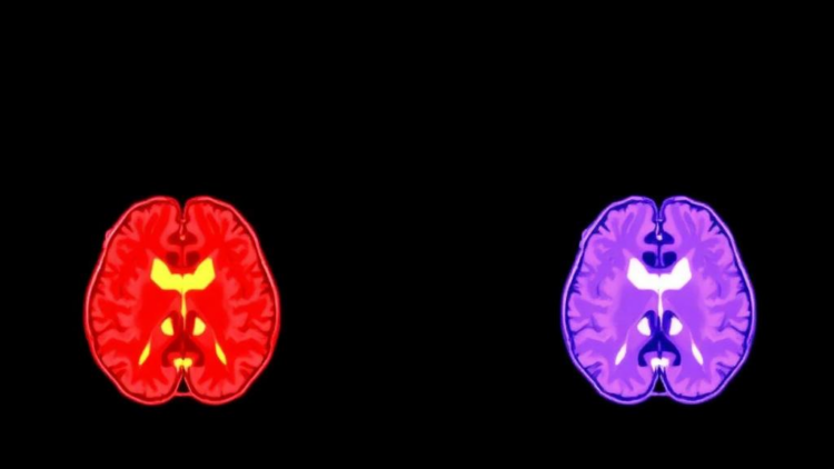 When Surgery Looks Better: The Hidden Bias in Motor Cortex Metastase Outcomes