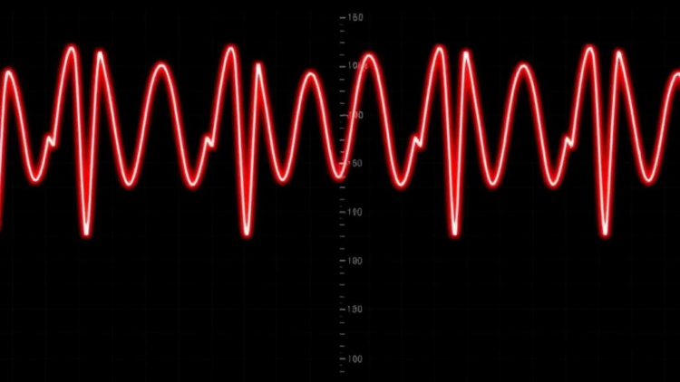 Inverted T-waves in Athletes Are Common but Usually Benign, Massive Analysis Finds