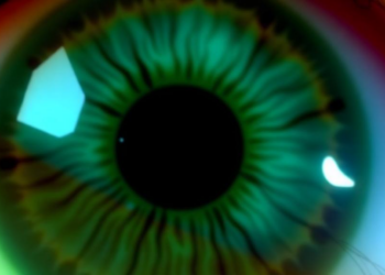 Multimodal AI Classifies Herpes Simplex Keratitis Subtypes Across Three Eye Centers