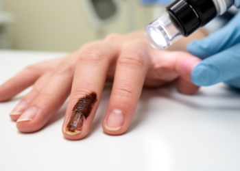 Persistent nail separation may hide a rare melanoma