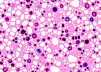 Two Proteins in Tiny Biopsies May Predict Survival in Pancreatic Cancer