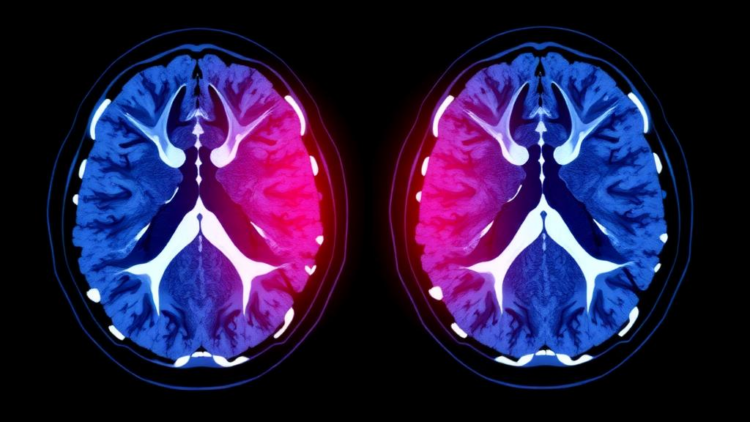 Penn AI model detects hidden disease signals in CT scans