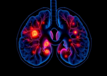Case report tracks aggressive pulmonary choriocarcinoma with brain metastases
