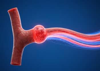 Physics-informed AI reduces errors in aneurysm flow reconstructions